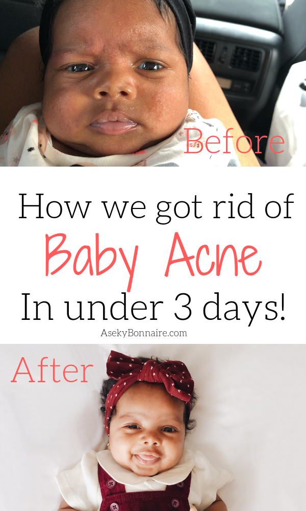 How To Get Rid Of Baby Acne Aseky Co